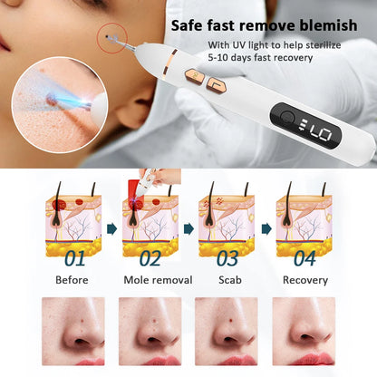 Laser Plasma Pen Remover Facial Mole Skin Tag Dark Spot Rechargeable Plasma Pen Warts Nevus Tattoo Freckle Papilloma Removal
